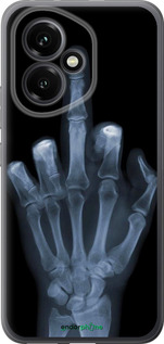 Силиконовый чехол Рука через рентген для Huawei Honor 400 5G - 1007u-4017 изображение 