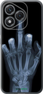 Силиконовый чехол Рука через рентген для Huawei Honor 400 Lite 5G - 1007u-3993 изображение 
