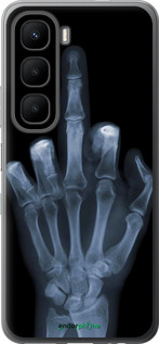 Силиконовый чехол Рука через рентген для Infinix Hot 60 5G / Hot 60i 4G - 1007u-4114 изображение 
