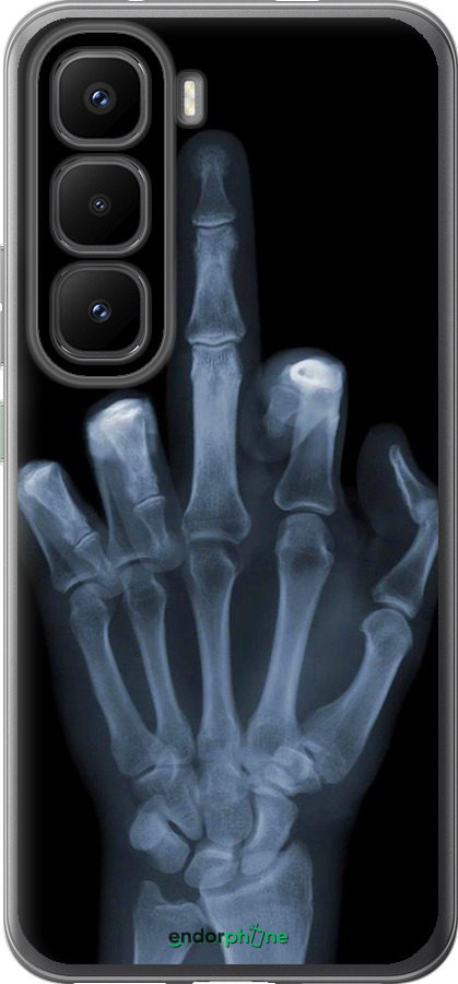 Силіконовий чехол Рука через рентген для Infinix Hot 60 Pro+ - 1007u-4125 изображение 