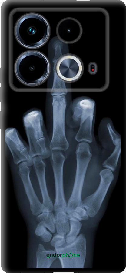 TPU чехол Рука через рентген для Infinix Note 40 - 1007b-3707 изображение 