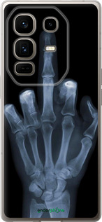Силіконовий чехол Рука через рентген для Infinix Note 50 Pro+ - 1007u-4041 изображение 
