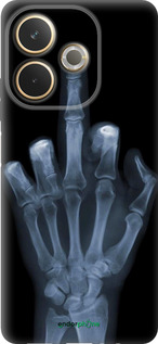 Силиконовый чехол Рука через рентген для Oppo A5 PRO - 1007u-3956 изображение 