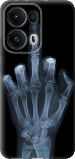 Силиконовый чехол Рука через рентген для Oppo Reno13 Pro - 1007u-3943 изображение 