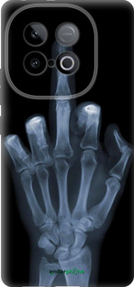 Силиконовый чехол Рука через рентген для Vivo IQOO Neo 10 5G - 1007u-3920 изображение 