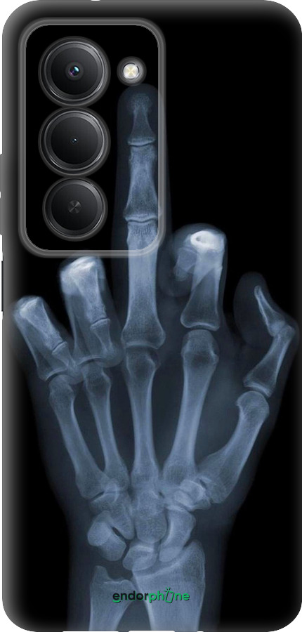 Силіконовий чехол Рука через рентген для Xiaomi Redmi 15 4G - 1007u-4136 изображение 