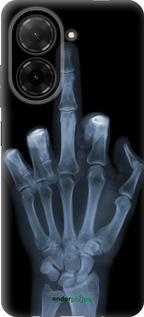 Силиконовый чехол Рука через рентген для Xiaomi Redmi A5 4G - 1007u-3926 изображение 