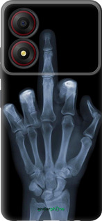 Силіконовий чехол Рука через рентген для ZTE Blade A34 - 1007u-3989 изображение 