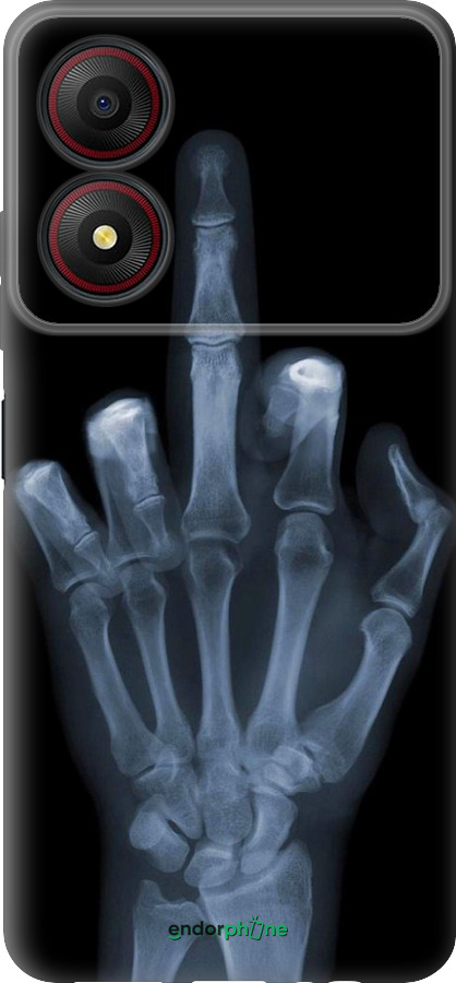 Силіконовий чехол Рука через рентген для ZTE Blade A34 - 1007u-3989 изображение 