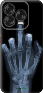 Силиконовый чехол Рука через рентген для ZTE Nubia V70 Design - 1007u-4084 изображение 