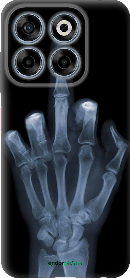 Силиконовый чехол Рука через рентген для ZTE Nubia V70 - 1007u-4083 изображение 