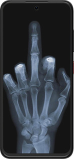 Силиконовый чехол Рука через рентген для ZTE Nubia V70 Design - 1007u-4084 изображение 